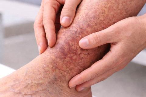 Как меняется кожа при хронической венозной недостаточности